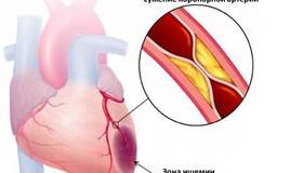 Гипертензивная болезнь с преимущественным поражением сердца